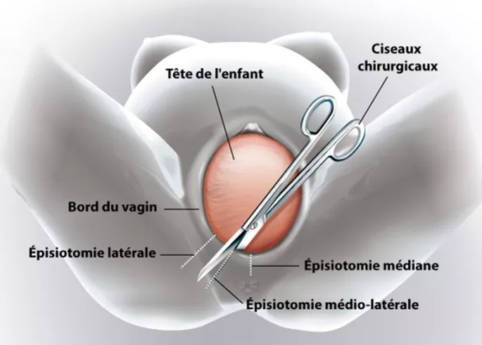 Épisiotomie