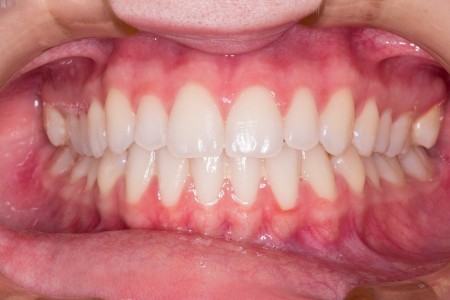 Gencives et dentition humaines