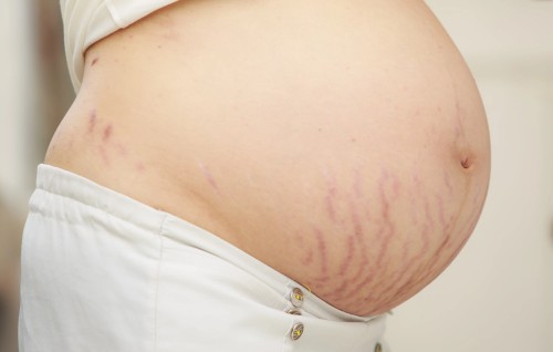 Vergetures dues à la grossesse